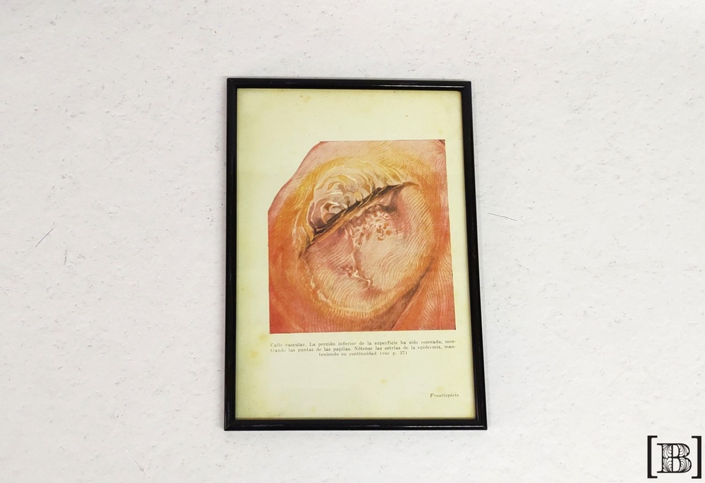 [DP00169] Cuadro lámina callo vascular